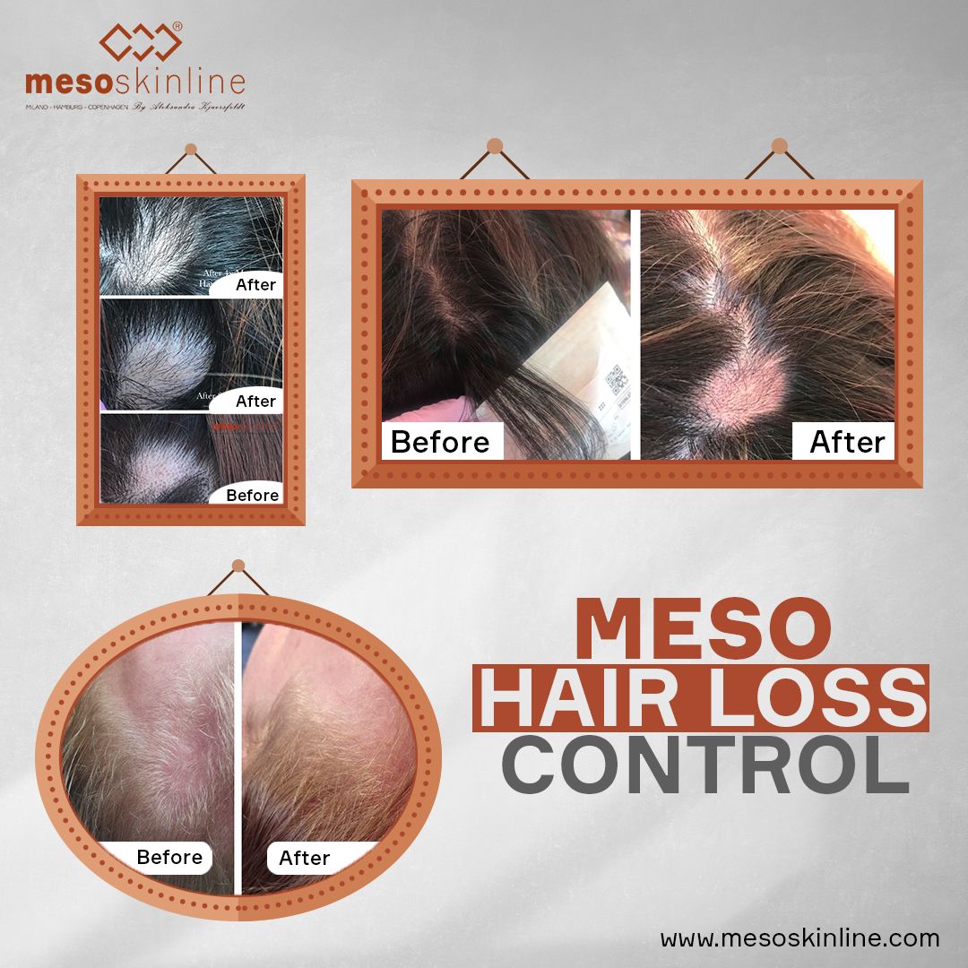 https://fyxheopqrpkpcjskstej.supabase.co/storage/v1/object/public/shop_gallery/46/mesoskinline-hair-growth-control.jpg